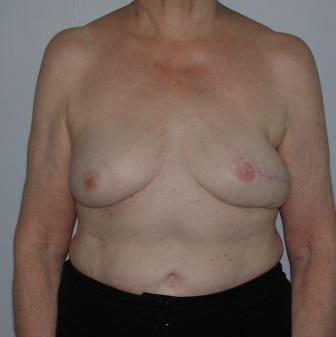 breast reconstruction surgeons