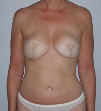breast reconstruction surgery