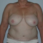breast restoration