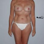 nipple sparing mastectomy