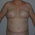 perforator flap breast reconstruction