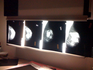 <alt="Mammogram Images"/>